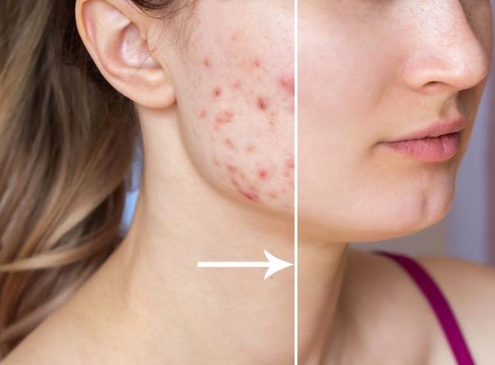 Explore the Best Acne Scar Treatment Options for Lasting Results and Improved Complexion