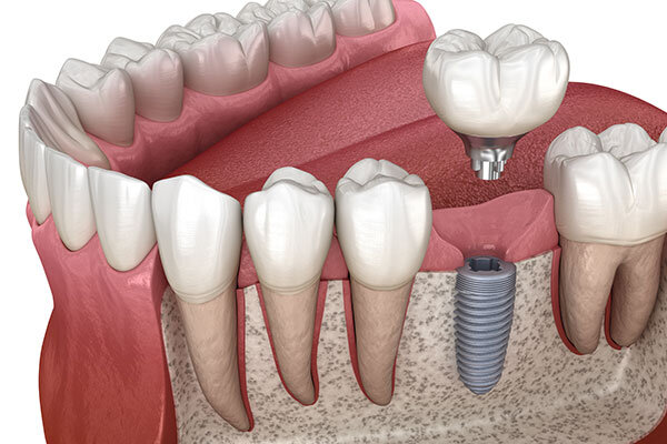 Dental Implants